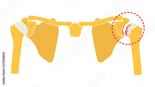 Osteoarthritis of the shoulder joint, degeneration of joint cartilage and the underlying bone. Vector illustration, flat design.