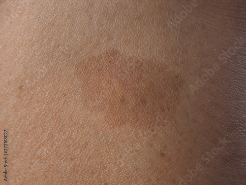 dark brow birthmark or cafe au lait ma or CLAMs on the skin leg woman using for health care and treatment pulsed dye laser concept. photo