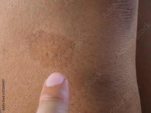 Fotografie woman finger select focus point to dark brow birthmark or cafe au lait ma or CLAMs on the skin leg using for health care and treatment pulsed dye laser concept
