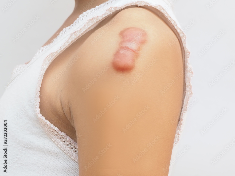 Φωτογραφία keloid scar of skin shoulder kid girl case of tissue forms over the wound to repair and larger than the original and treatment of laser to reduce size