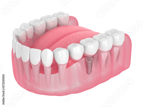 3d render of jaw with implant supported dental cantilever bridge