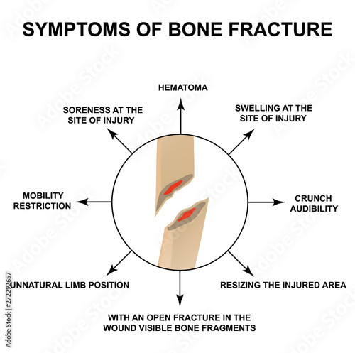 Symptoms of bone fracture. Bone fracture with displacement. Infographics. Vector illustration on isolated background.