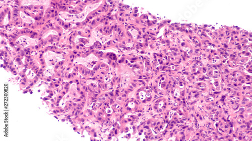 Fototapeta Naklejka Na Ścianę i Meble -  Microscopic image of core biopsy of liver showing metastatic cancer of the pancreas (pancreati