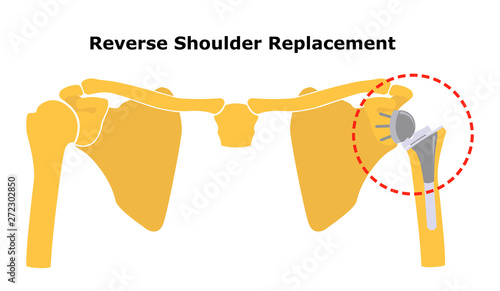 Reverse Shoulder Replacement. Shoulder joint replacement, endoprosthetics. Osteoarthrosis of the shoulder joint. Vector illustration. Flat design.