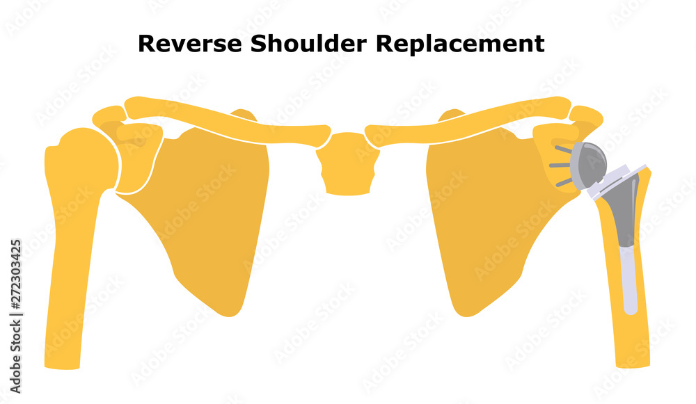 reverse-shoulder-replacement-shoulder-joint-replacement