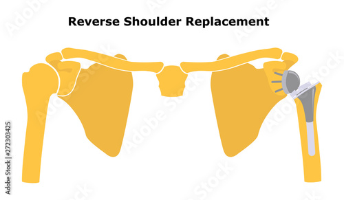 Reverse Shoulder Replacement. Shoulder joint replacement, endoprosthetics. Osteoarthrosis of the shoulder joint. Vector illustration. Flat design.