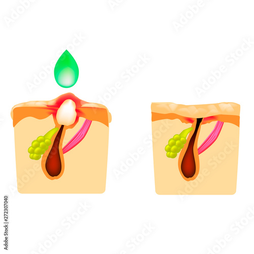 Treatment of open comedones, inflamed acne, acne cysts. Sore acne. The structure of the skin. Treatment of scars of acne and pimples. Peeling. Infographics. Vector illustration on isolated background.