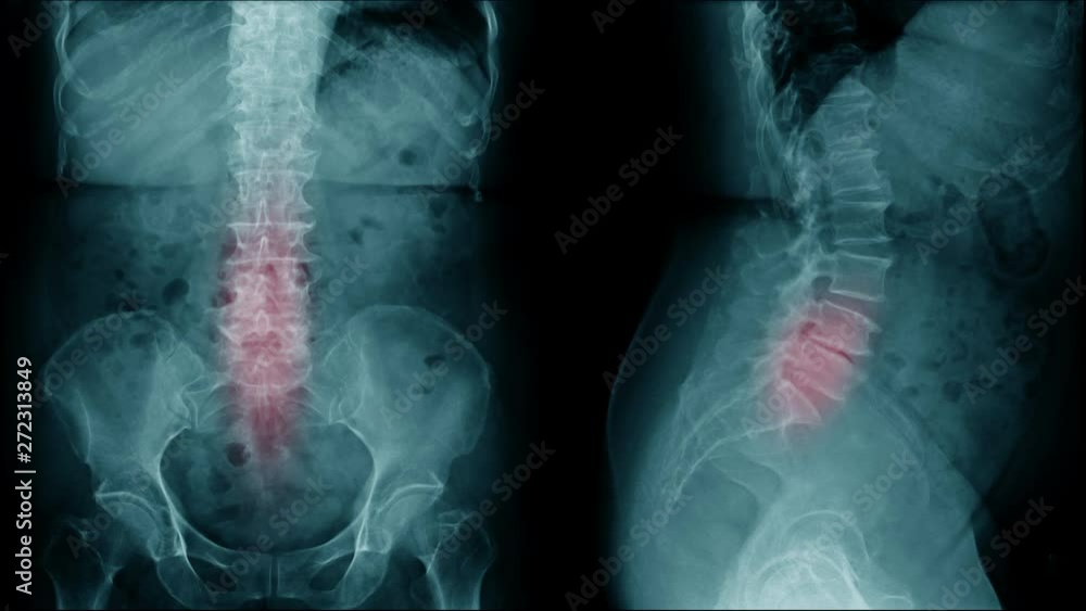back pain xray footage of lumbar spondylosis, 4K footage of back pain