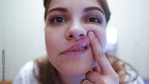 Young woman with a sore lip. Aphthous stomatitis is a common condition characterized by the repeated formation of benign and non-contagious mouth ulcers. Canker sores photo