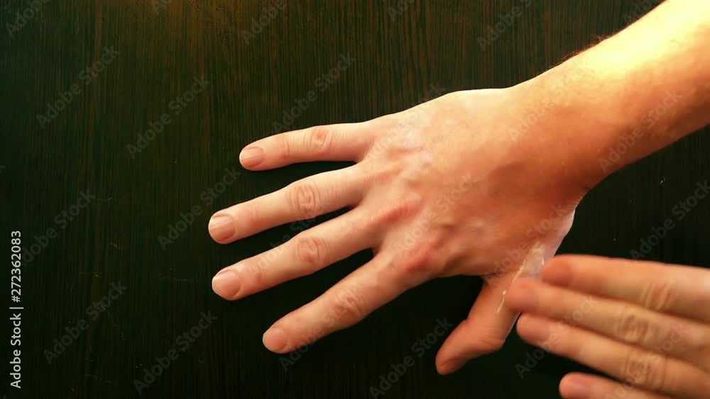 close up of the hand with white spots on the skin of vitiligo treatment ...
