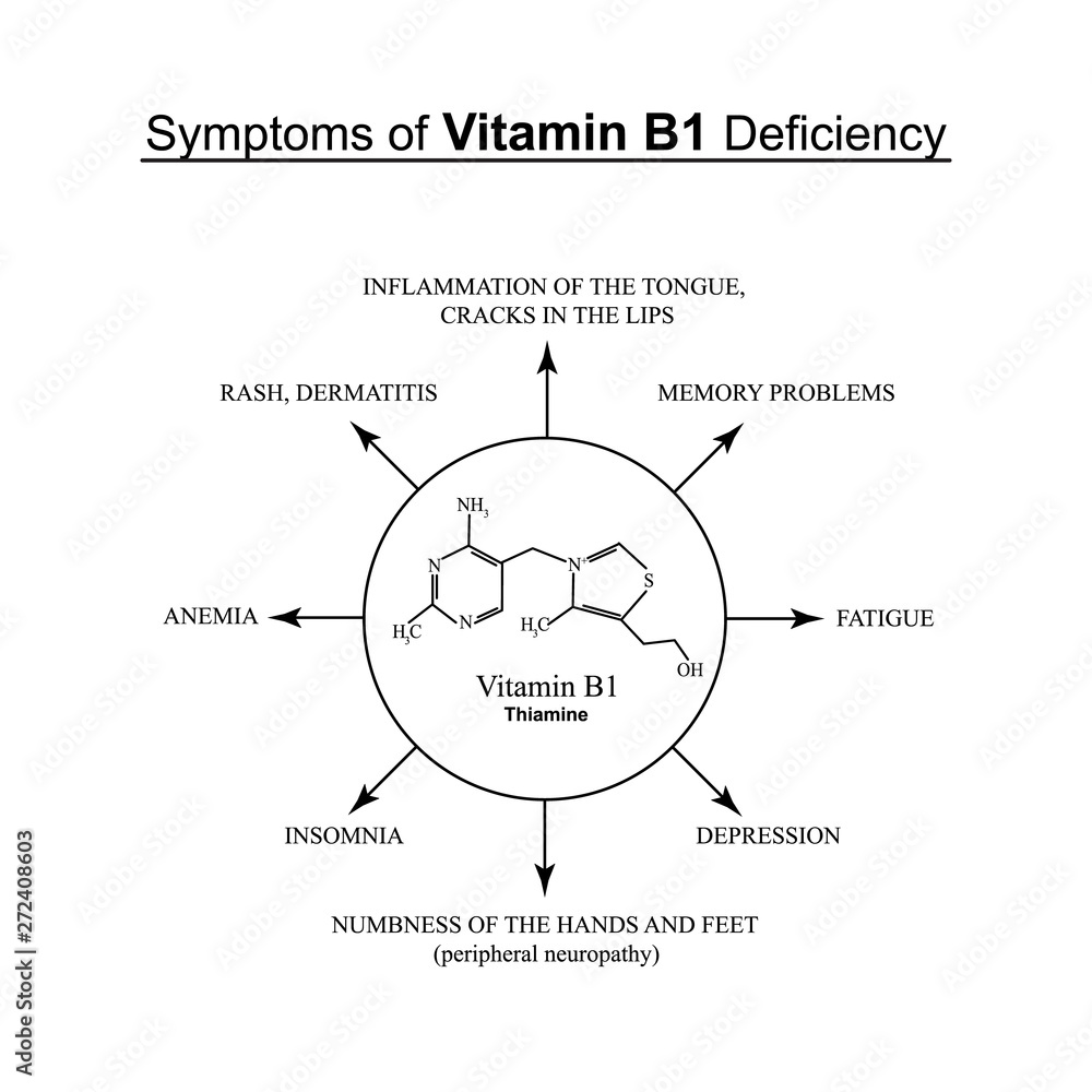 Symptoms of vitamin B1 deficiency. Infographics. Vector illustration on