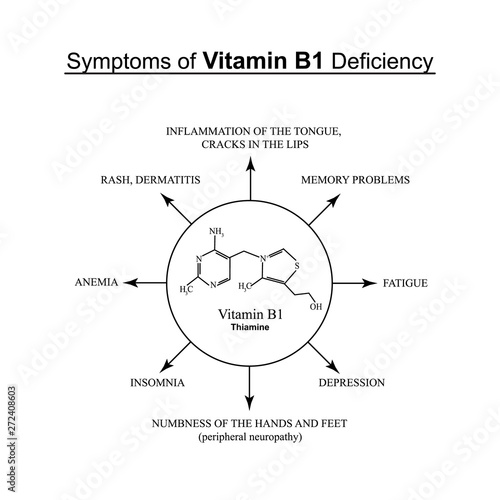 Symptoms of vitamin B1 deficiency. Infographics. Vector illustration on an isolated background.