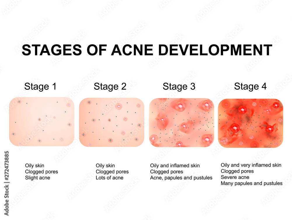 Stages Of Development Of Acne Inflamed Skin With Scars Acne And