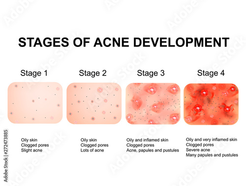 Stages of development of acne. Inflamed skin with scars, acne and pimples. The texture of inflamed skin, and acne and pimples. Infographics. Vector illustration.