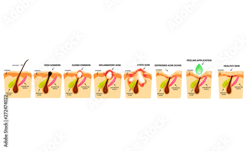 Treatment of open comedones, inflamed acne, acne cysts. Sore acne. The structure of the skin. Treatment of scars of acne and pimples. Peeling. Infographics. Vector illustration on isolated background.