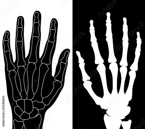 Rheumatoid arthritis of the hands. Black silhouettes isolated on white background. illustration