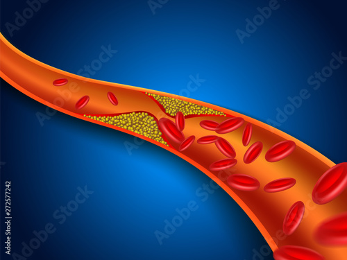 Cholesterol is clogged in the blood vessels. Vector EPS file.