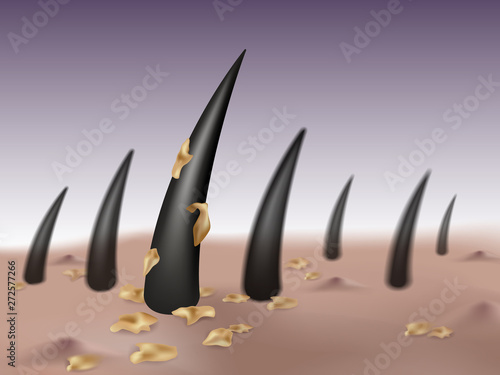 Dandruff in hair and scalp Causing germs and blisters or pimples on the head. Vectro realistic file.