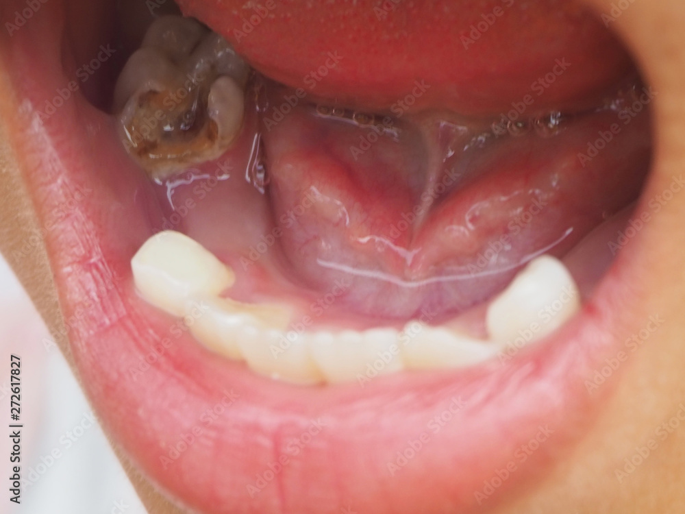 Open mouth showing teeth caries or tooth decay of lower molar Open mouth showing teeth caries or tooth decay of lower molar