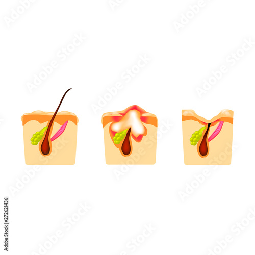 comedones, inflamed acne, cysts. Inflamed pimples. The structure of the skin. Scar acne and pimples. Infographics. Vector illustration on isolated background.