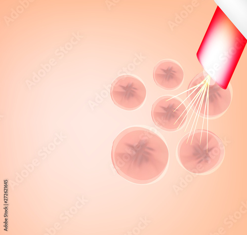 Skin scars after acne and pimples. Treatment of scars on the skin of the face with a laser. Infographics. Vector illustration on isolated background.