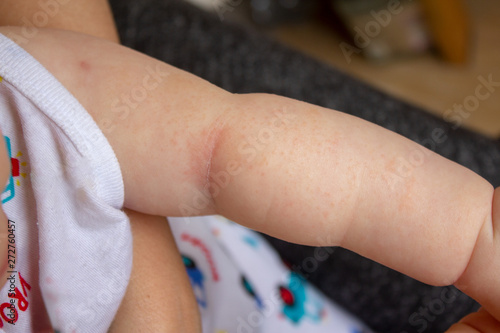 Prickly heat. Close-up of the folds of the hand of a newborn baby with red skin. 