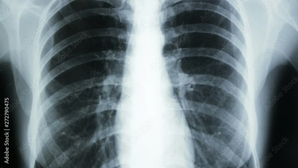 Vertical tracking, of a X-ray plate of the human thorax. Vertical tracking, of a X-ray plate of the human thorax.