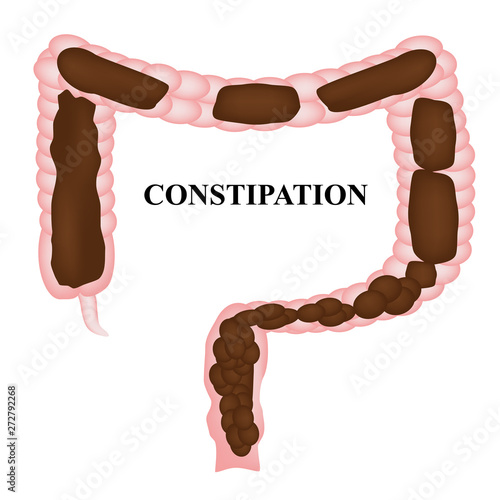 Constipation. Feces in colon. Infographics. Vector illustration on isolated background.