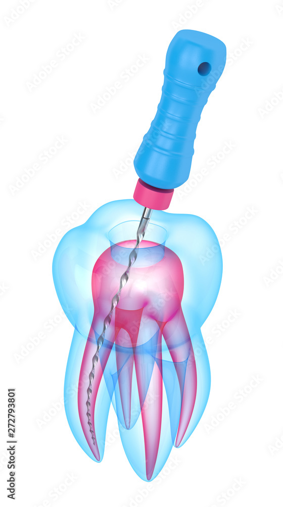 3d render of tooth with endodontic file over white background 3d render of tooth with endodontic file over white background
