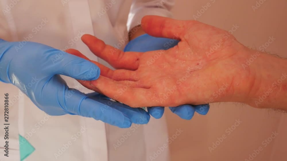 Doctor examining patient with dermatitis on hands, closeup. Doctor examining patient with dermatitis on hands, closeup.