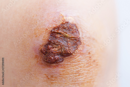 Scar and scab (eschar) on asian female knee photo