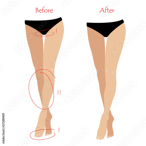 Woman epilation or depilation concept - legs and bikiny zone before and after unwanted hair removing. Vector