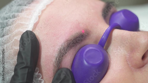Removal of an old tattoo with a laser in an aesthetic medicine clinic.