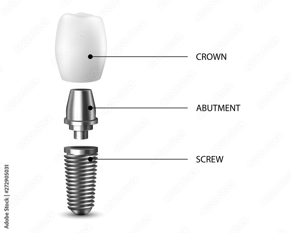 Vector 3d Realistic Render White Tooth Implant Denture Closeup Isolated on White Background. Dental, Medicine and Health Concept. Design Template of Prosthesis Structure. Front View Vector 3d Realistic Render White Tooth Implant Denture Closeup Isolated on White Background. Dental, Medicine and Health Concept. Design Template of Prosthesis Structure. Front View