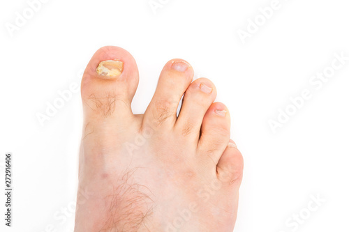 A young males foot infected with toenail fungus on a white Background. photo