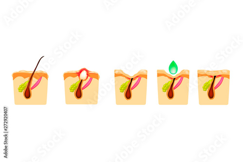 Treatment of open comedones, inflamed acne, acne cysts. Sore acne. The structure of the skin. Treatment of scars of acne and pimples. Peeling. Infographics. Vector illustration on isolated background.