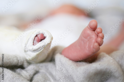 Closeup of newborn little baby with leg in a cast - clubfoot photo