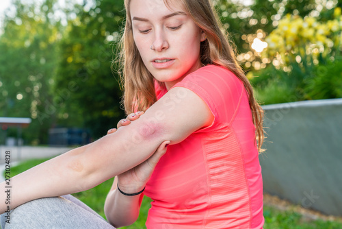 young woman examines her insect sting on her arm
