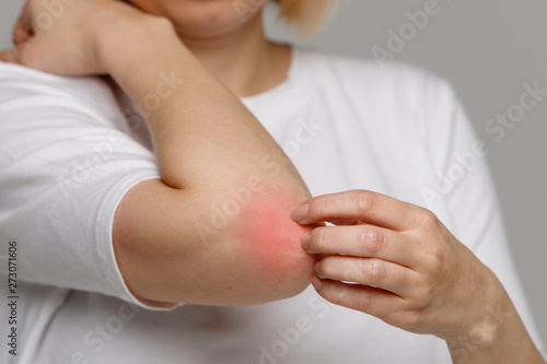 Close up of young woman scratching her arm and red elbow from allergy, isolated on grey background. Dry skin, dermatitis, insect bites, irritation, rash concept. 