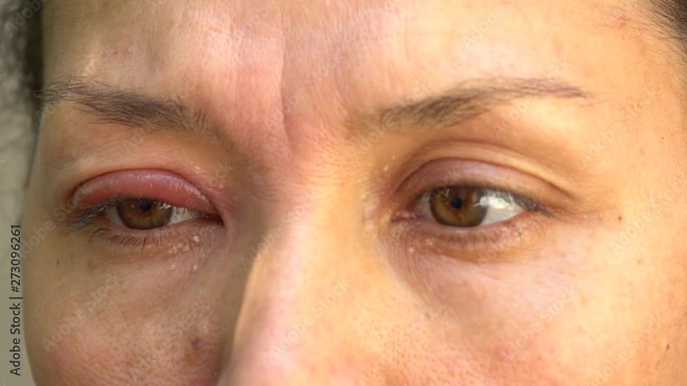 A stye, a hordeolum, a bacterial infection of an oil gland in the