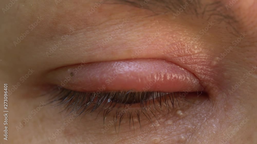 Video „A stye, a hordeolum, is a bacterial infection of an oil gland in