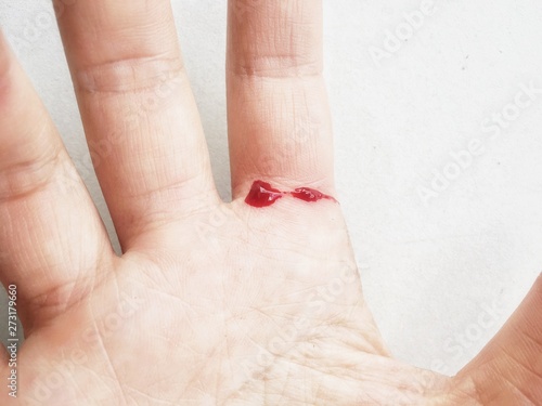 finger on right human hand was cut and bleeding with red blood from fresh wound