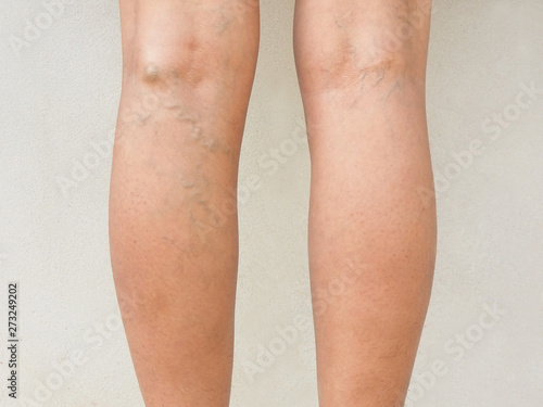 Varicose veins on leg woman on cement wall background using for health care concept.