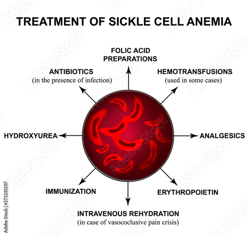 Treatment of sickle cell anemia. World Sickle Cell Anemia Day 19 June. Red blood cells. Erythrocytes Sickle. Infographics. Vector illustration on isolated background.