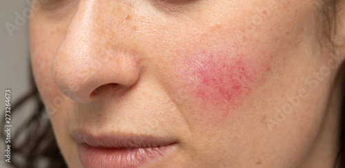 Woman with blotchiness on the cheek caused by bacterial infection photo
