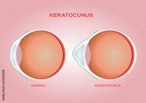 eye cornea and keratoconus vector / anatomy photo
