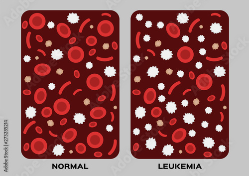 leukaemia / human blood concept / white and red blood cell vector