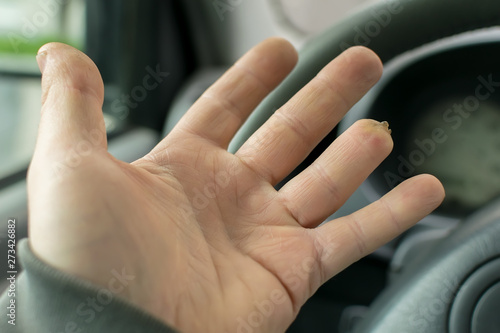Hand of a man with a missing finger phalanx on the background of the steering wheel and dashboard of the car