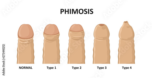 Canvas Types of phimosis. Vector illustration