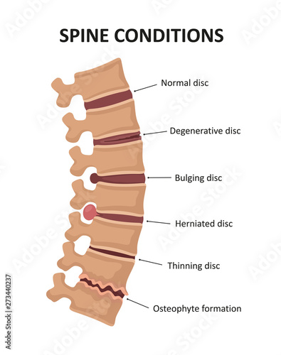 Stages of spinal osteochondrosis. Degenerative Disc. Bulging Disc. Herniated Disc. Thinning Disc